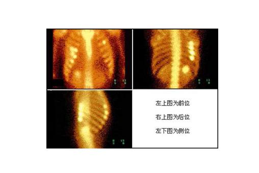 25(oh)d的生成减少而发生佝偻病,血钙低,血磷高.需要使用1.