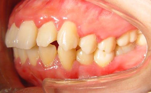 又称牙性龅,牙齿性龅牙是由于恒牙在生长过程中,由于牙弓过小,从而使