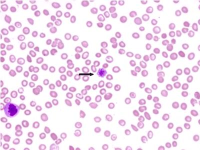 血小板减少+-+搜狗百科