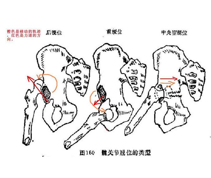 3,患肢缩短,髋关节呈屈曲,内收,内谢畸形.