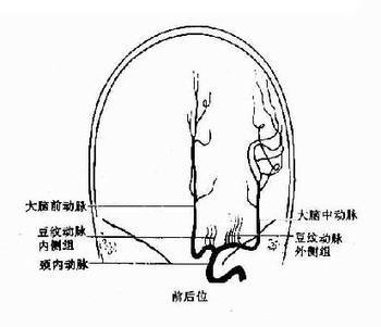 豆纹动脉闭塞