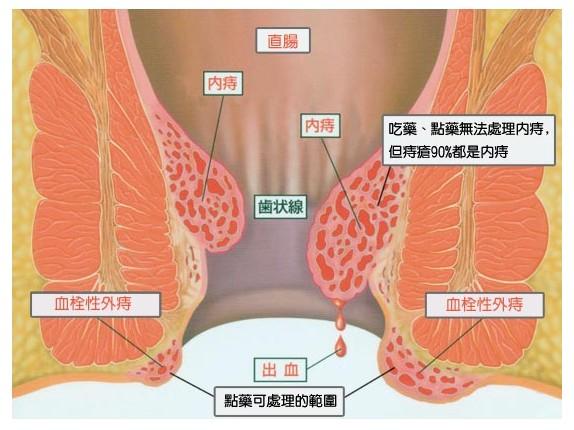 时内痔被擦破出血