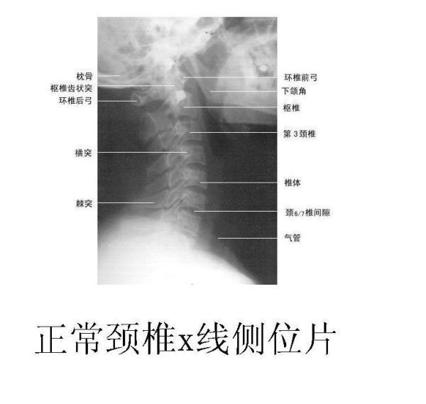 x线张口位摄片主要特征表现是枢椎齿状突与寰椎两枚侧块间距不对称,但