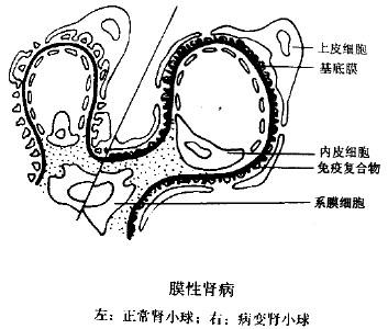 肾小球基底膜蛾噬现象