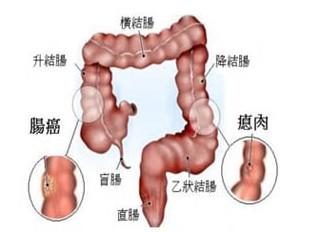 盲肠癌