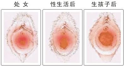 处女膜修复手术