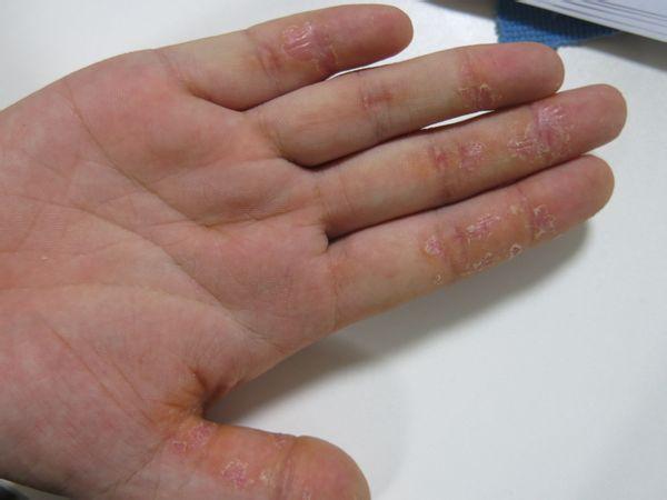 2.手部湿疹 为过敏性皮肤病.