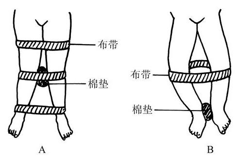  膝内翻 +-+搜狗百科