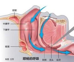 腺样体面容