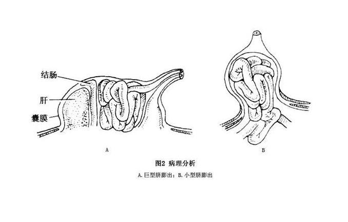 脐膨出