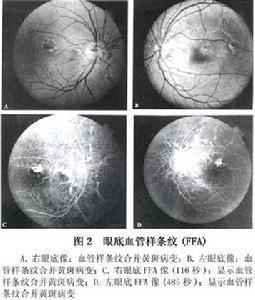 眼底发现黄斑呈带灰色变色