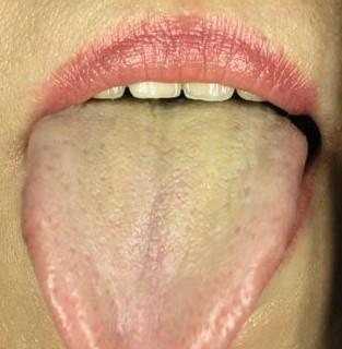 舌苔薄白而润为正常人的舌苔,同时,苔薄白亦是表示病在体表而未入里.
