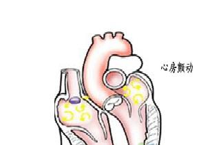 病因治疗房颤的病因治疗至关重要,积极治疗原发性心脏病才容易使房颤