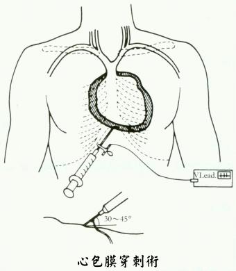 心包膜穿刺术