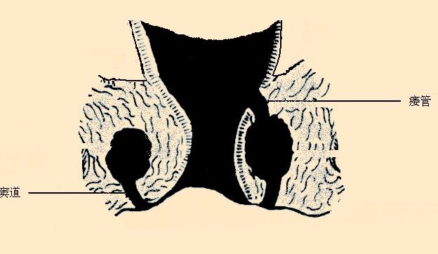会阴瘘管或窦道形成