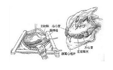 慢性缩窄性心包炎