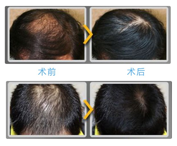 郑盛日是国际毛发<em>移植</em>整形学会正式会员