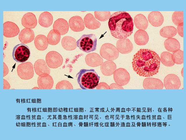 外周血中出现有核红细胞表示骨髓中红细胞系增生明显; 有核红细胞