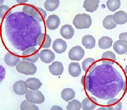 髓单核细胞白血病-+搜搜百科