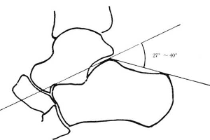 图1—跟骨结节角