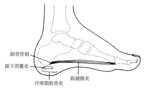 足跟痛