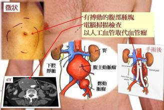 合并马蹄肾的腹主动脉瘤