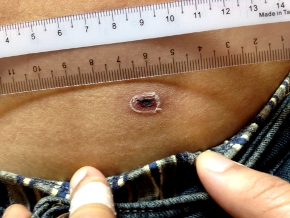 恙虫咬了可以吃糯米吗