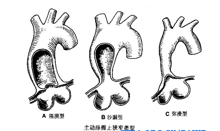 狭窄病变位于冠状动脉开口的上方.主动脉瓣上