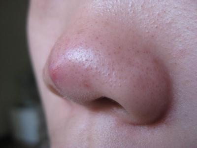 酒渣鼻:面部除红丘疹外,鼻尖及颊部毛细血管扩张性红斑.毛囊口常扩大.