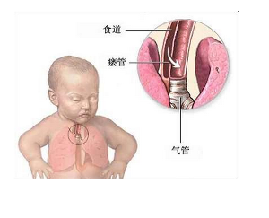 食管气管瘘