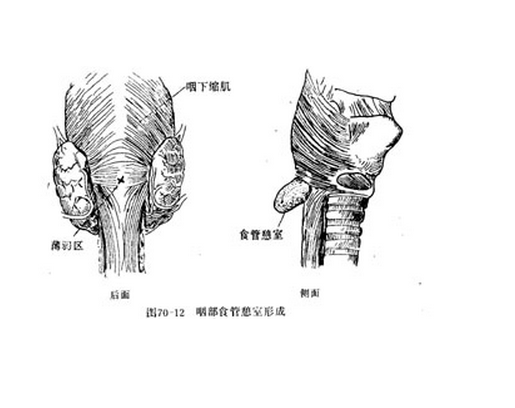 咽食管憩室