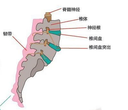 腰椎间盘突出