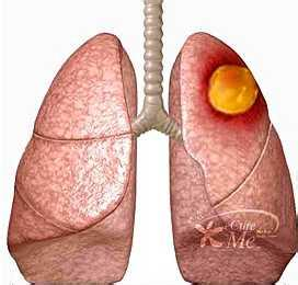 肺癌早期症状