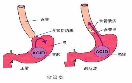 胃食管返流症