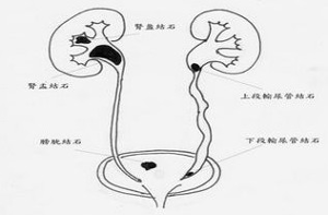 老年人泌尿系统感染