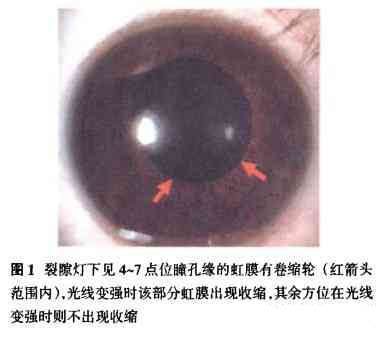 瞳孔紧张症