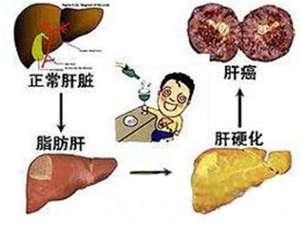 如果是营养过剩性脂肪肝的人,饭前20分钟饮水,使胃有一定的饱胀感,可