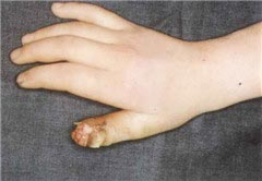 蛇头疮,即手指末节指腹皮下组织化脓性的感染