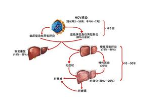 庚型病毒性肝炎