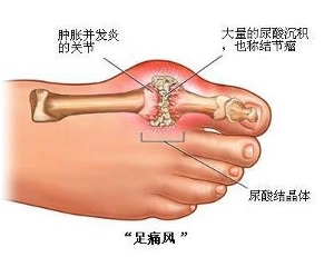 脚痛风-百科