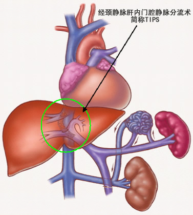 脾大和脾功能亢进