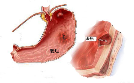 胃糜烂