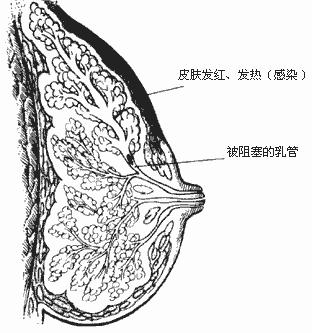 哺乳期乳腺炎症状