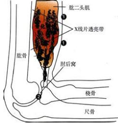 常发生于靠近骨或骨膜的软组织.骨化性肌炎一词不恰当,因为骨骼