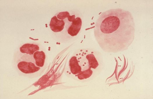 如双球菌不在细胞内则属于可疑,但应注意淋病早期时淋病奈瑟菌大多都