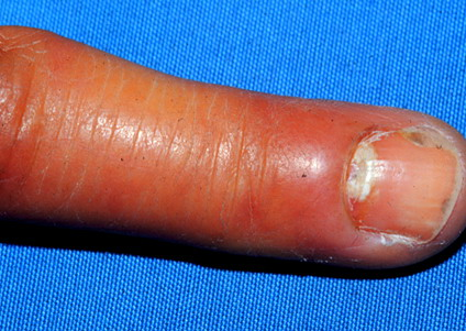 本病见于有咬手指怪癖的儿童.为慢性黏膜皮肤念珠菌病症状的一部分.