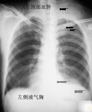 呼吸困难 气胸发作时病人均有呼吸困难,其严重程度与发作的过程,肺被