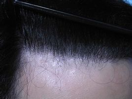 发际线后移