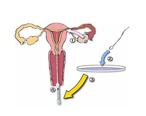 根据推注药液时阻力的大小及液体返流的情况,判断输卵管是否通畅
