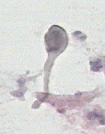 表皮囊肿是怎么形成的 搞笑图片